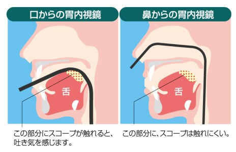 胃カメラ検査の種類|西宮の胃カメラ検査なら大岡クリニック